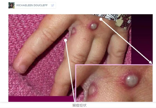 “毁容”病毒!世卫组织发布猴痘疫情预警,欧美多国出现人际传播休闲区蓝鸢梦想 - Www.slyday.coM “毁容”病毒!世卫组织发布猴痘疫情预警,欧美多国出现人际传播休闲区蓝鸢梦想 - Www.slyday.coM