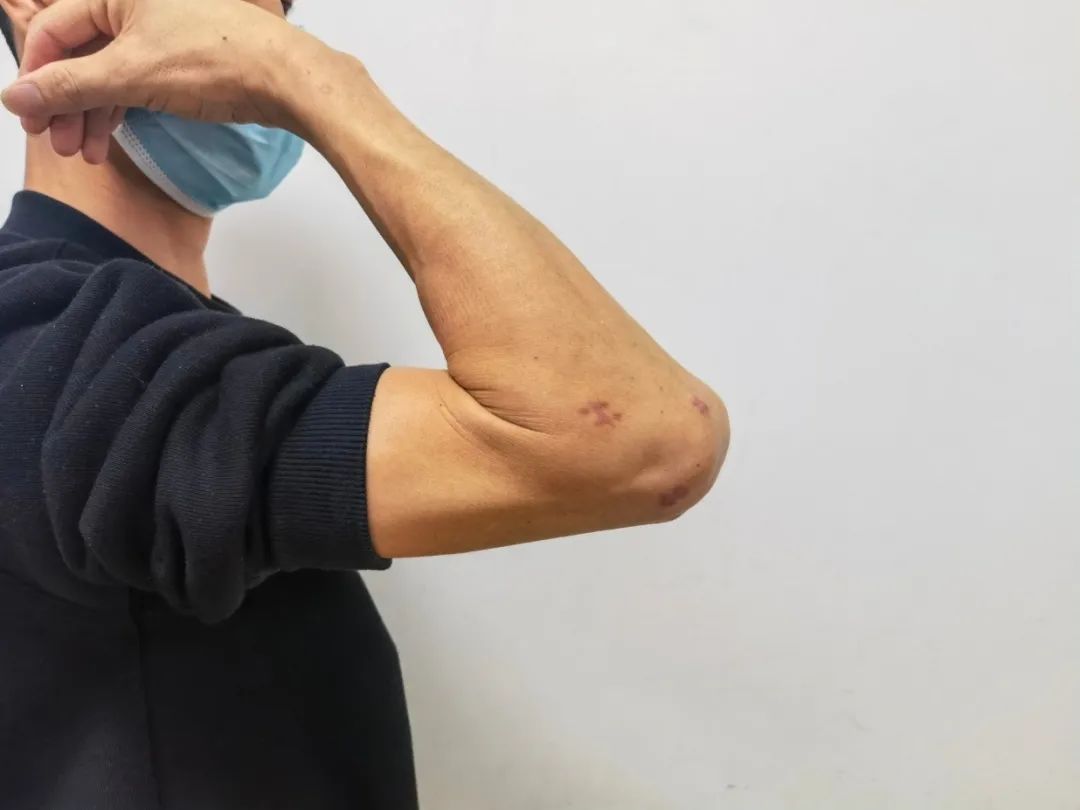 惊呆肘关节莫名疼痛医生竟取出5颗珍珠