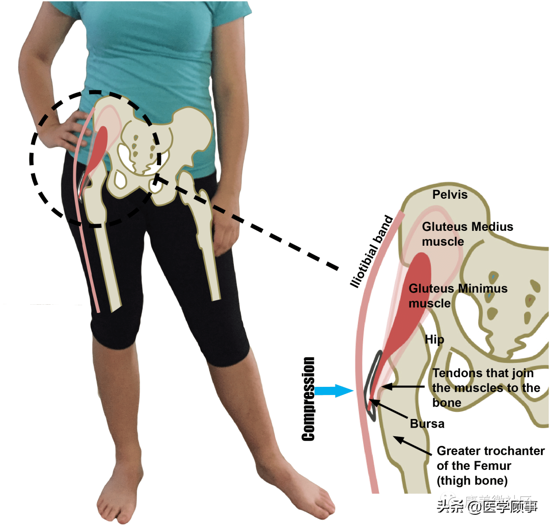 股骨头坏死在荣成康阳医院能治好吗?