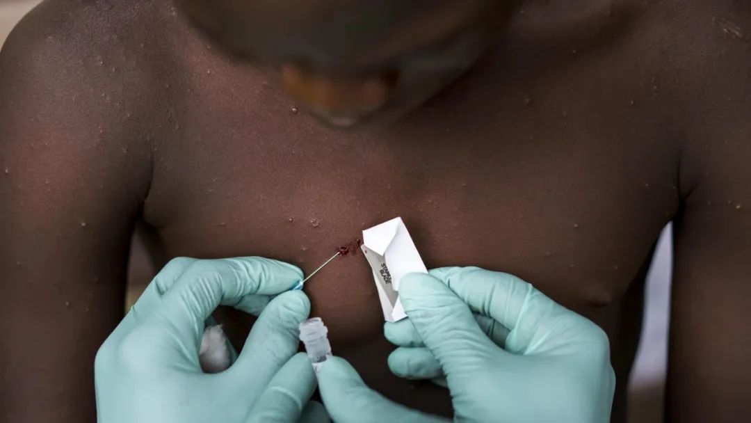 拜登称猴痘病毒还未上升到新冠水平！世卫组织：主要通过性传播休闲区蓝鸢梦想 - Www.slyday.coM