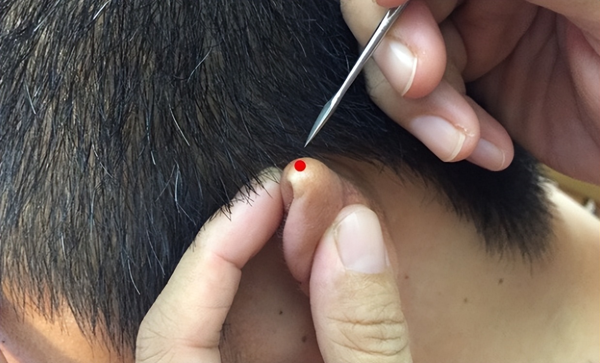 神奇的耳尖放血显奇效能治11种病