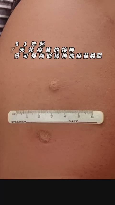 胳膊上有疤,种过“牛痘”就不会得猴痘?|胳膊_新浪新闻