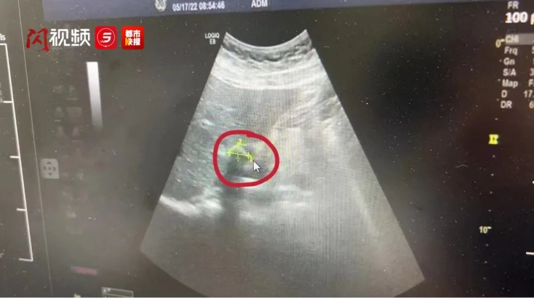 西安宝妈坐月子每天8个鸡蛋吃成胆结石？医生：鸡蛋不背锅休闲区蓝鸢梦想 - Www.slyday.coM