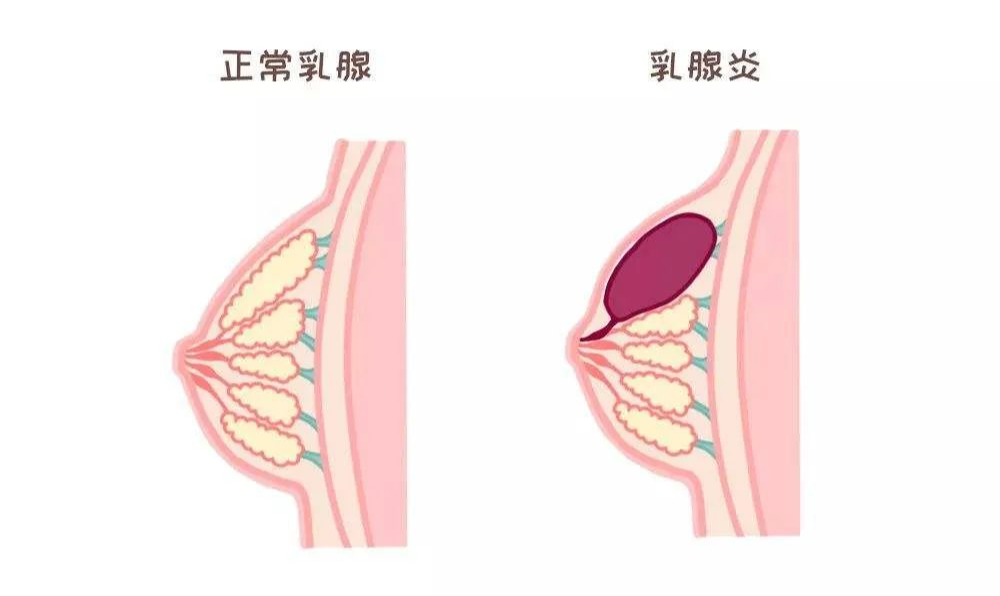 急性乳腺炎,中医专家有办法|急性乳腺炎|乳头|哺乳_新浪新闻