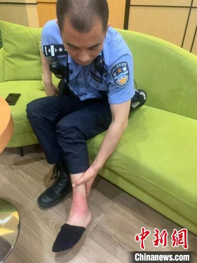 民警踩着燃烧木炭灭火脚踝烫伤引朋友圈泪目