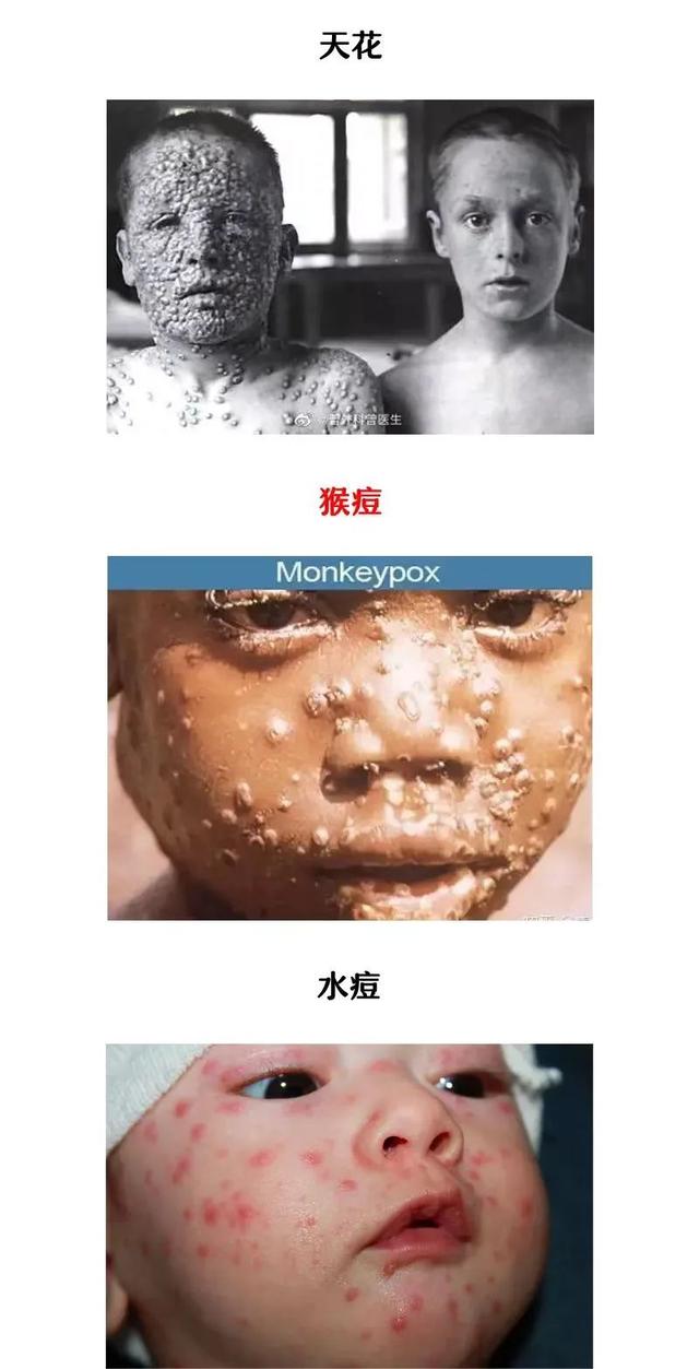 引起水痘的是水痘-带状疱疹病毒,和引起猴痘,天花,牛痘的病毒没有密切