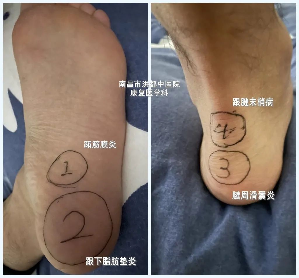 的部位不同,引起足跟附近不同区域的疼痛,比如跖筋膜炎,跟下脂肪垫炎