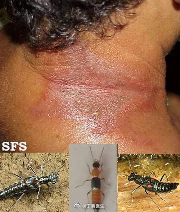 如果有虫子爬到身上,千万不要贸然拍死! 举个隐翅虫的例子……休闲区蓝鸢梦想 - Www.slyday.coM 如果有虫子爬到身上,千万不要贸然拍死! 举个隐翅虫的例子……休闲区蓝鸢梦想 - Www.slyday.coM