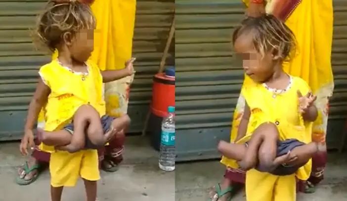 2岁“蜘蛛女孩”：腰部多长出一对手脚，4手4脚引围观！休闲区蓝鸢梦想 - Www.slyday.coM