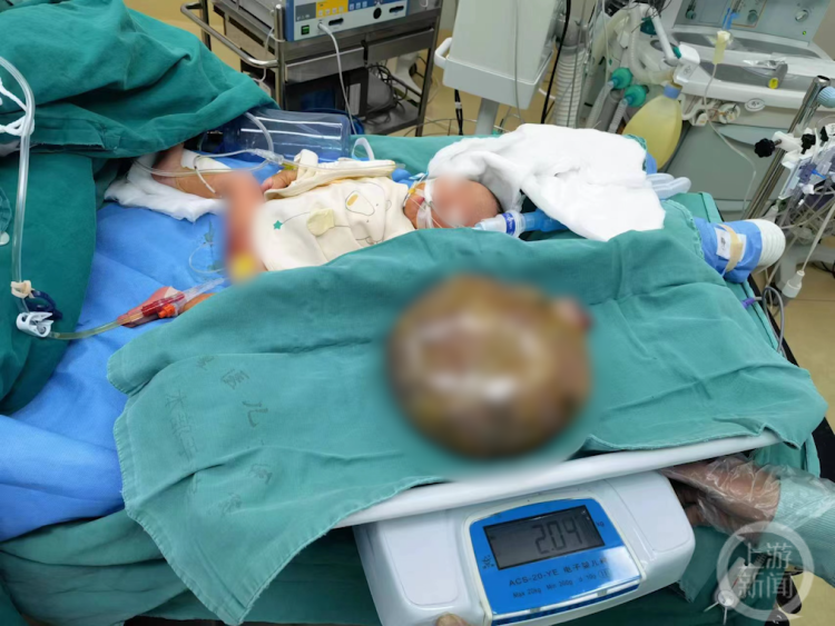 据肿瘤外科专家介绍,骶尾部是儿童畸胎瘤好发部位,大多数都是良性