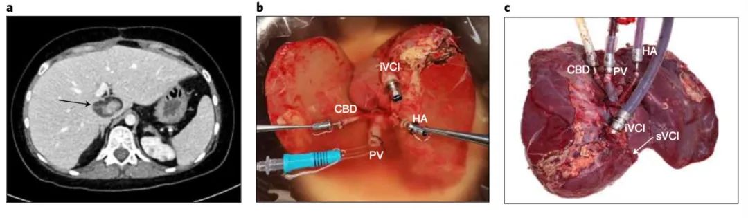 保存三天的人体肝脏移植成功。图源：《自然·生物技术》在线
