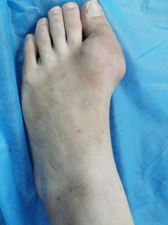 慈惠医院纪实25岁小伙痛风双脚大拇指长满石头饮食习惯惹的祸