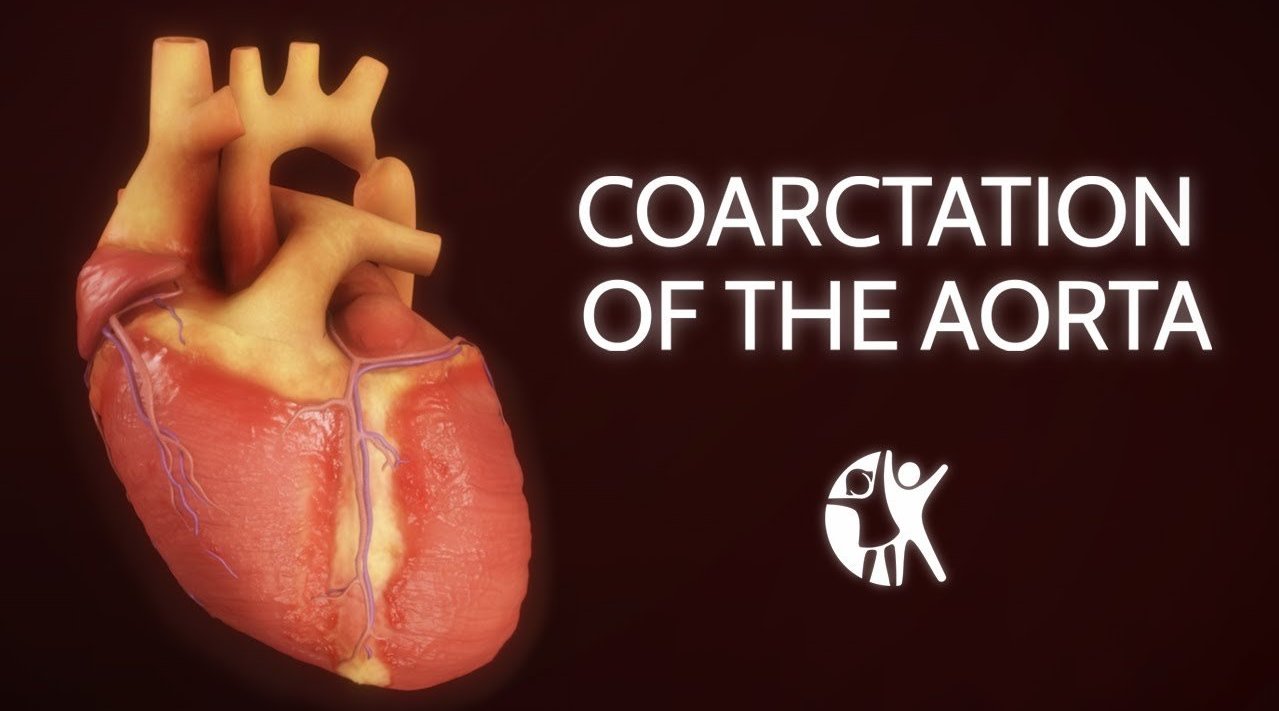 医学动画 - 主动脉缩窄