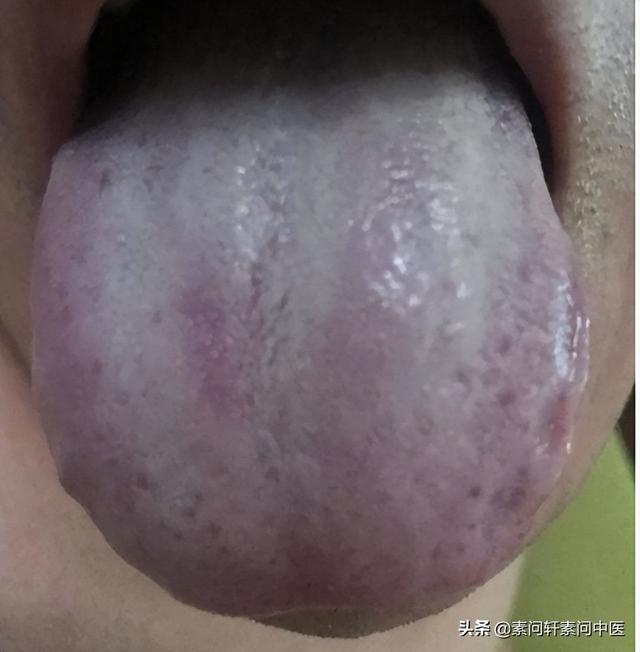 舌质偏红底子偏热舌苔白腻偏寒湿他夏天非常喜欢踢足球踢好足球一身汗