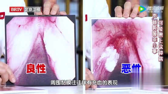 常见危险因素,尽量早避开~|声带白斑|声带|病变_新浪新闻