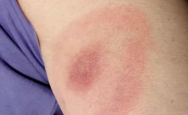 致死率高达30%,被夺命蜱虫咬了,该如何自救?__财经头条