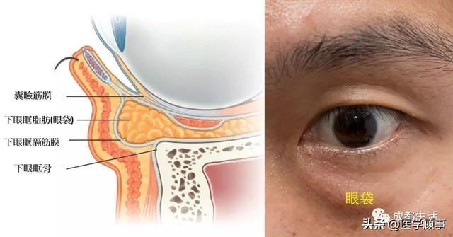 不开刀就能祛眼袋