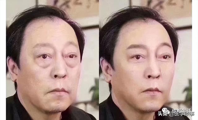 之前奇葩说里,马东老师割眼袋整个人年轻了很多!