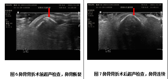 孩子鼻骨骨折怎么办 医生 不要慌 尽早复位 鼻骨骨折 鼻腔 骨折 新浪新闻