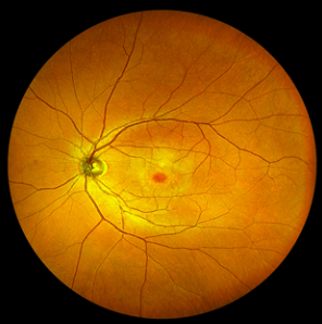 罗静说,医生通过给患者眼底照相,可以看到患者的视网膜,视神经,黄斑