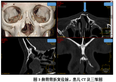 孩子鼻骨骨折怎么办 医生 不要慌 尽早复位 鼻骨骨折 鼻腔 骨折 新浪新闻