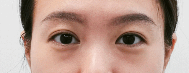 不开刀就能祛眼袋