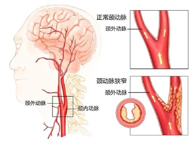 体检加做颈动脉b超及早发现中风风险