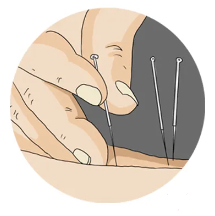 皮肤针,埋针,针刀,刺络法(三棱针法,放血法),温针法,烧针法等.