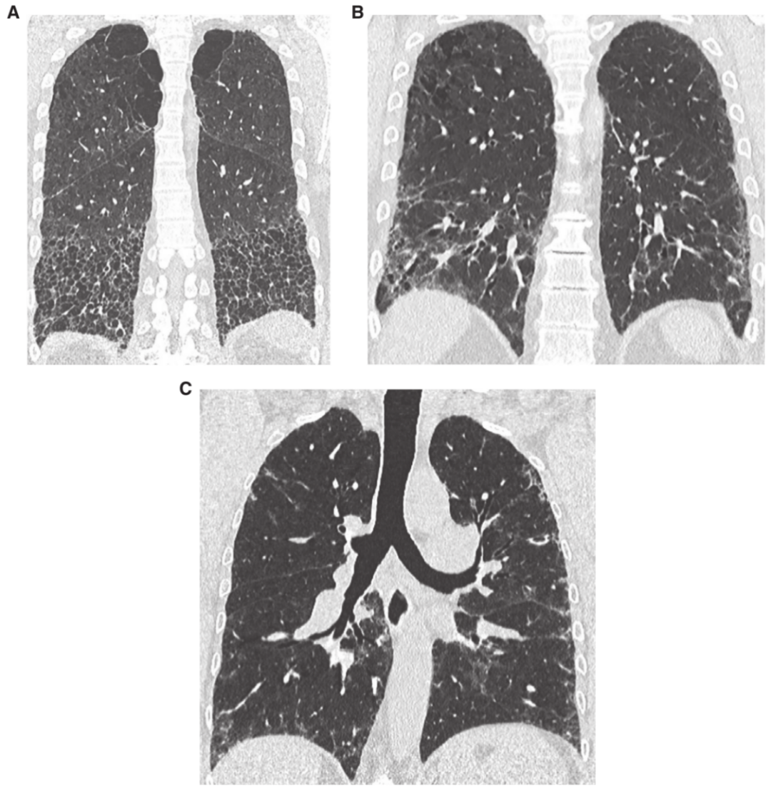 肺纤维化治疗用什么药 吗 尼达尼布与吡非尼酮的用法用量副作用