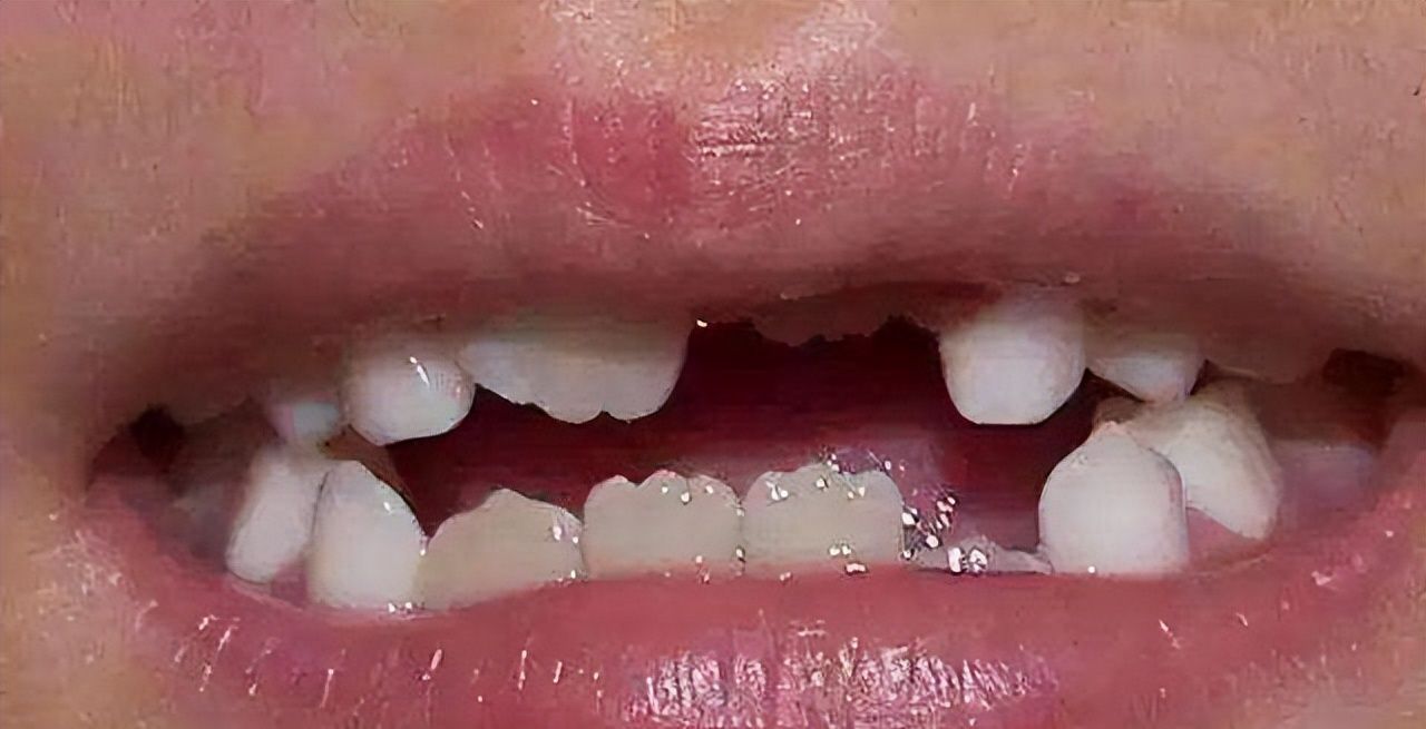 乳牙到恒牙没换好会出现哪些情况长出健康美观的牙齿不容易