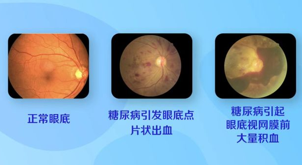 惊看眼科竟查出糖尿病一眼识透全身疾病出现这些症状赶紧自查