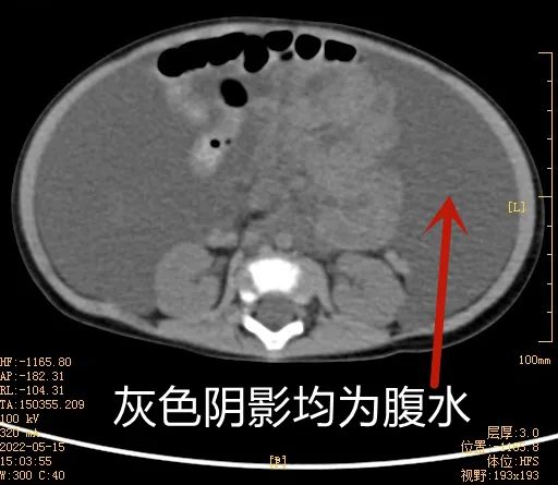 很快,腹部ct结果出来了:提示腹腔大量积液!其余腹部未见明显异常.