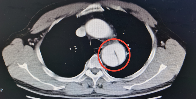 男子咳嗽4个月不见好转检查却发现致命的主动脉夹层