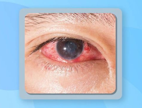 惊看眼科竟查出糖尿病一眼识透全身疾病出现这些症状赶紧自查