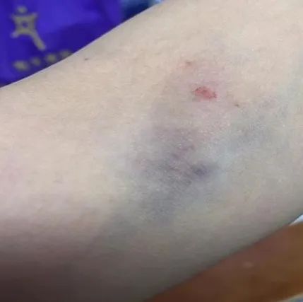 抽血后淤青、鼓包，该谁背锅？|血管|护士|针眼|肘部|棉签_新浪新闻