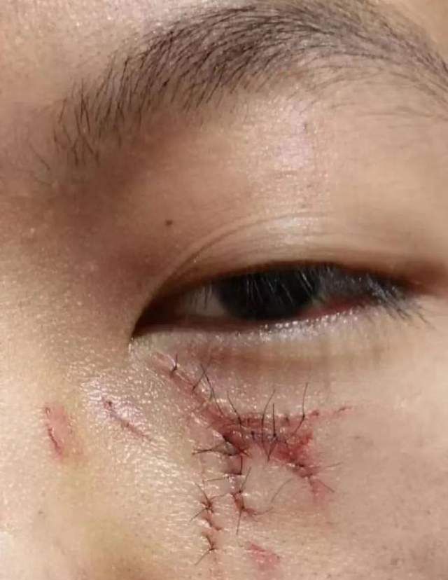 榆林15岁男孩被老师拳打,脸部被缝16针,父母心如刀绞泪如雨下__财经