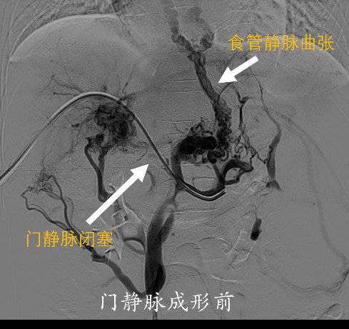 华西医院为6岁患儿成功实施经介入门静脉成形术 解决长达5年消化道出血问题休闲区蓝鸢梦想 - Www.slyday.coM