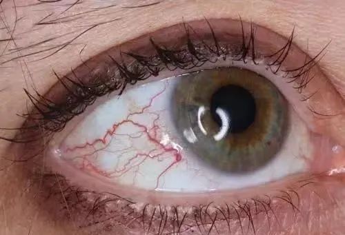 眼睛发红知多少巩膜炎你了解吗