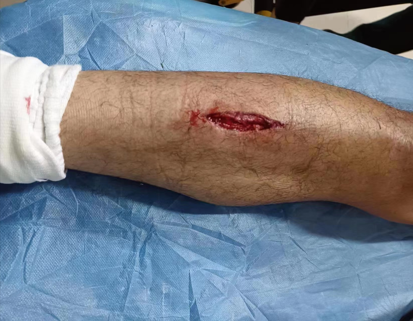 武汉长江13武汉三镇许东遭铲被抬进救护车小腿伤口触目惊心