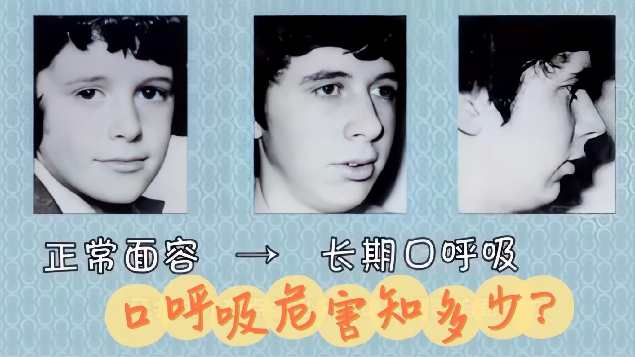 家长们注意孩子口呼吸面容可能会变形专家教你口呼吸如何纠正