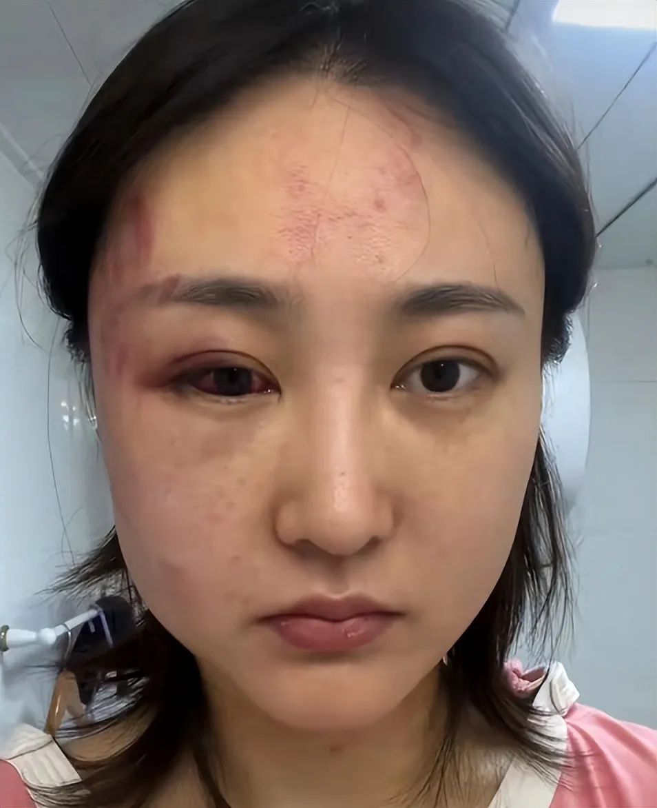 34岁女星遭家暴后现身派出所打到眼出血被鉴定轻伤老公已拘留