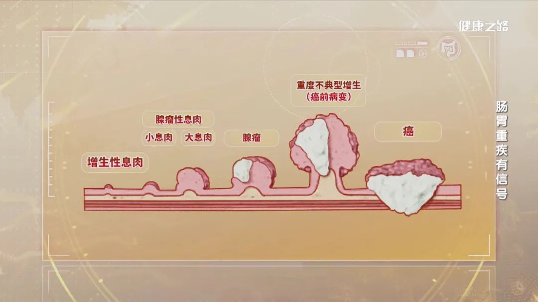 消化科专家提醒：这5种情况，可能是癌症的报警信号！休闲区蓝鸢梦想 - Www.slyday.coM