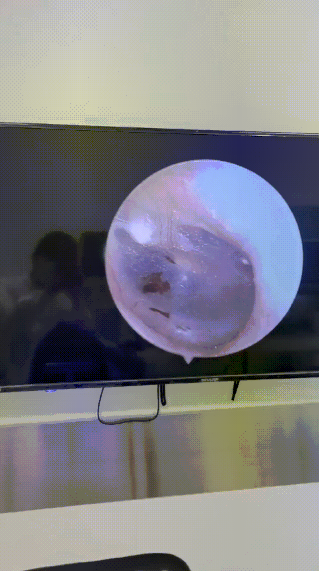 内窥镜下耳朵里看见虫子在动突如其来的耳鸣竟跟宠物有关