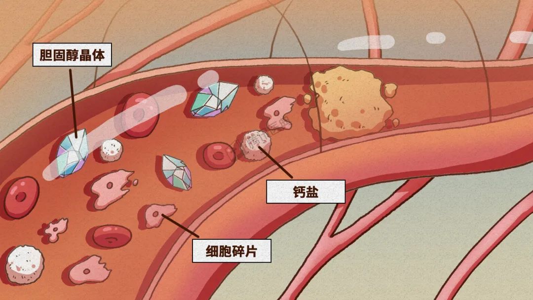 熬夜、奶茶、夜宵,会让你的血管发生什么?_新浪财经_新浪网