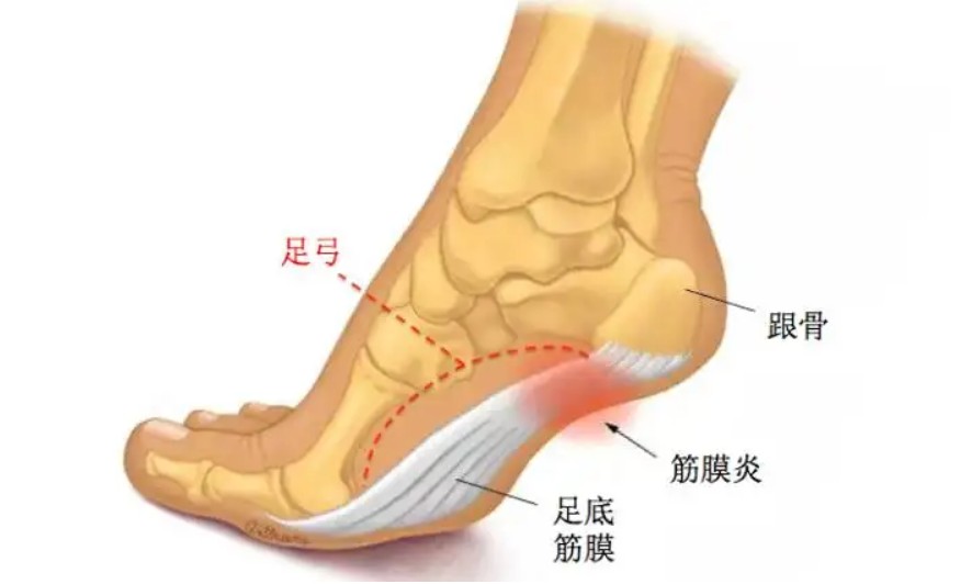 可能和以下情況有關:骨質疏鬆,蹠筋膜炎,跟部滑囊炎,跟骨骨刺,跟骨