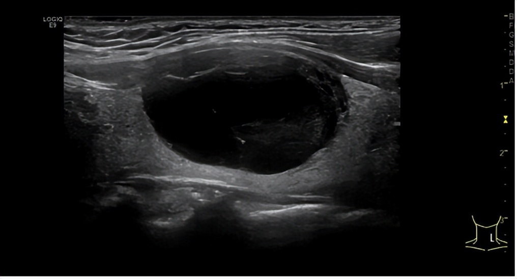 体检发现甲状腺患结节，超声引导微创消融，半小时快速解忧休闲区蓝鸢梦想 - Www.slyday.coM