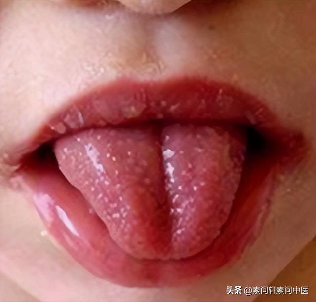 孩子口腔溃疡皮肤疖肿手足心热这种阳热体质该怎么办