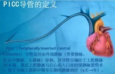 如何应对PICC置管导致的静脉炎,你知多少?|血管|输液_新浪新闻