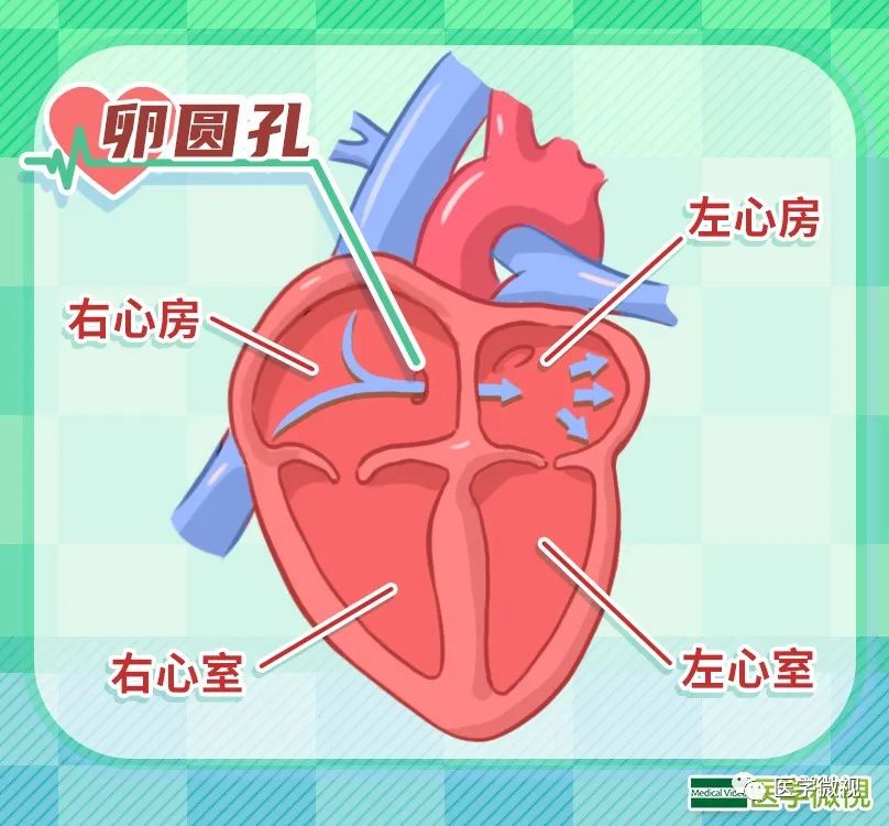 卵圆孔|房间隔|心脏_新浪新闻