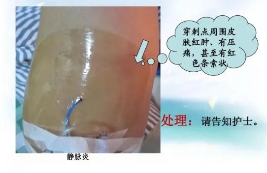 如何应对picc置管导致的静脉炎你知多少